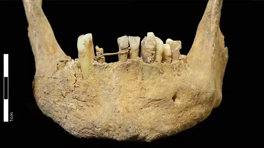 Ponte dentária de 500 anos encontrada na Escócia.